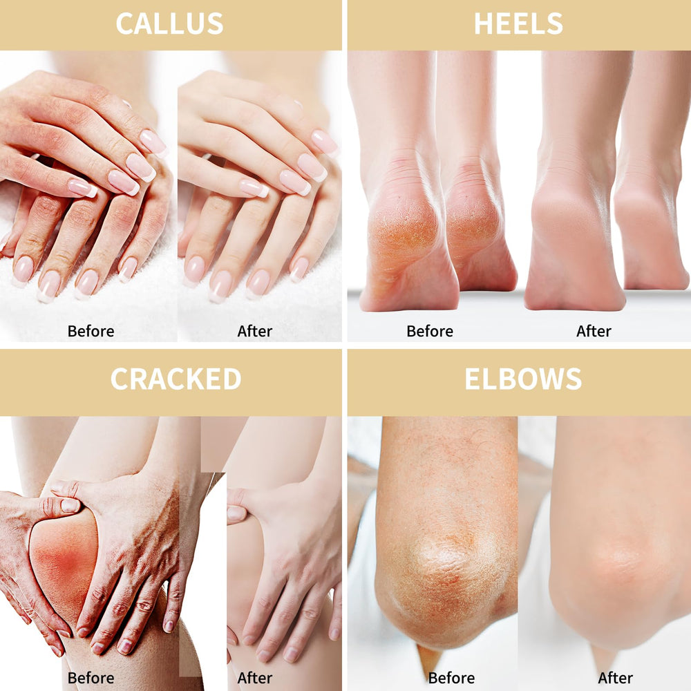Grocerism Urea Cream for feet, hands, elbows and knees for versatile use.
