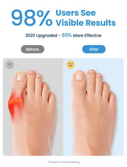 Habioer toe separators with ergonomic fit reduce friction between big toe and second toe.