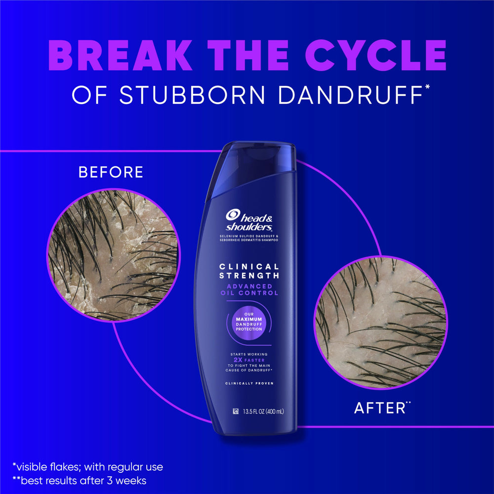 Head & Shoulders Clinical Strength hair before after shows scalp improvement with regular use.