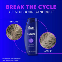 Head & Shoulders Clinical Strength hair before after shows scalp improvement with regular use.