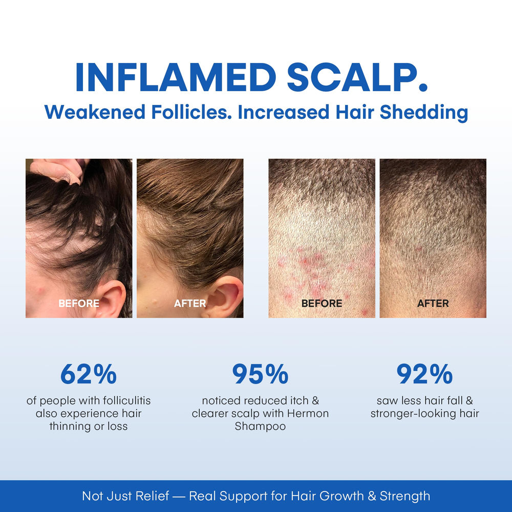 Hermon product packaging display showing the complete care kit for scalp and body.