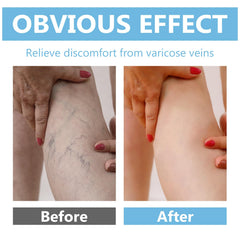 ITECFREELY Varicose Veins Cream beside high heels for daily routine.