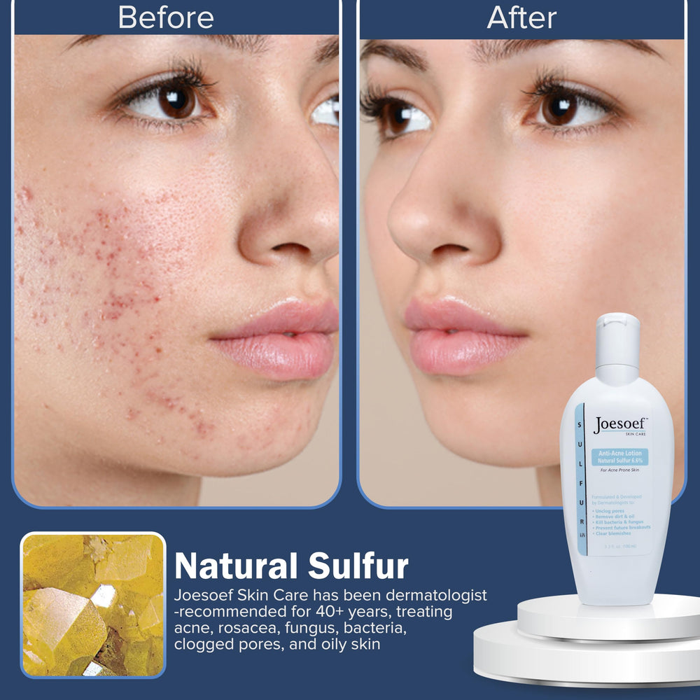 JOESOEF Skin Care packaging box explains the acne-prone skin routine