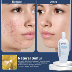 JOESOEF Skin Care packaging box explains the acne-prone skin routine