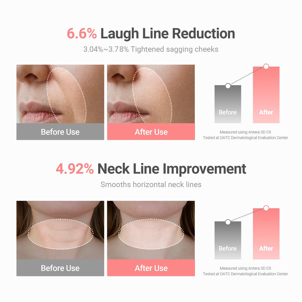 KAHI Wrinkle Bounce softens nasolabial folds around the mouth for smoother appearance.