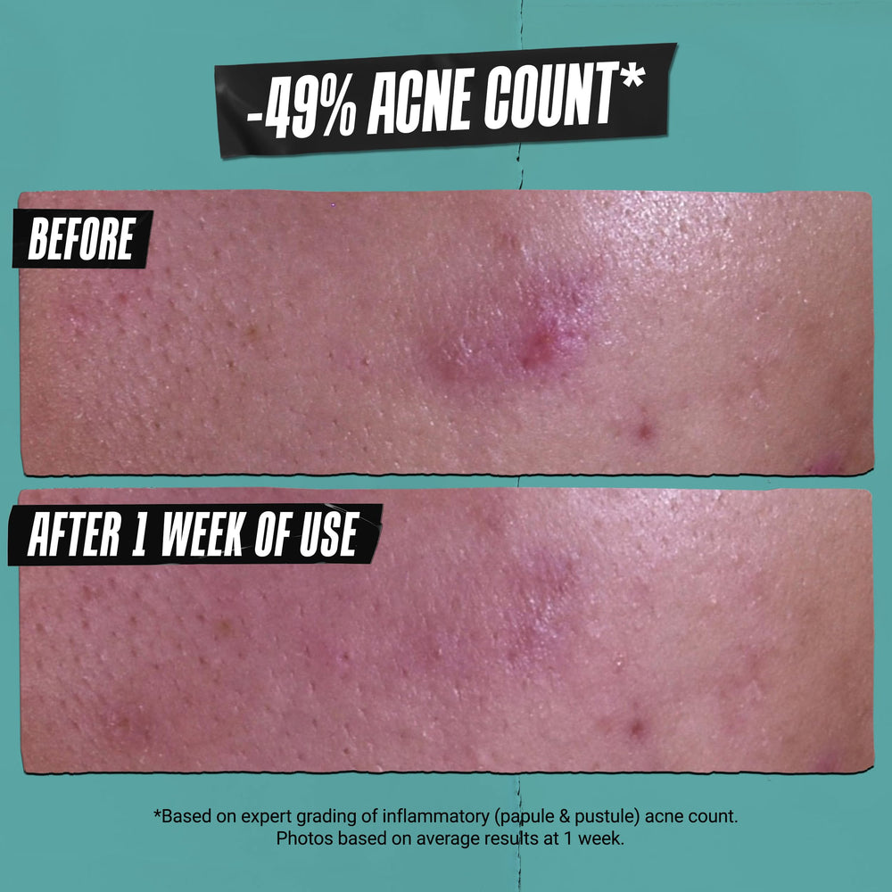Kiehl's Acne-Treating Cleansing Paste face mask application demonstrates purifying action