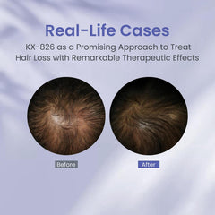KINTOR KX-826 uses mild ingredients to reduce irritation