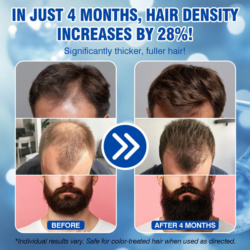 LIPEND Minoxidil spray bottle applying evenly to thinning areas