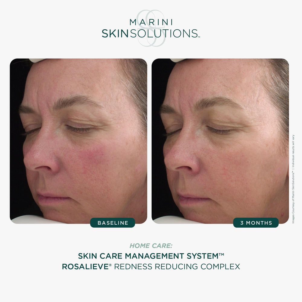RosaLieve tetrapeptide-14 packaging focus suggests peptide support for skin comfort.
