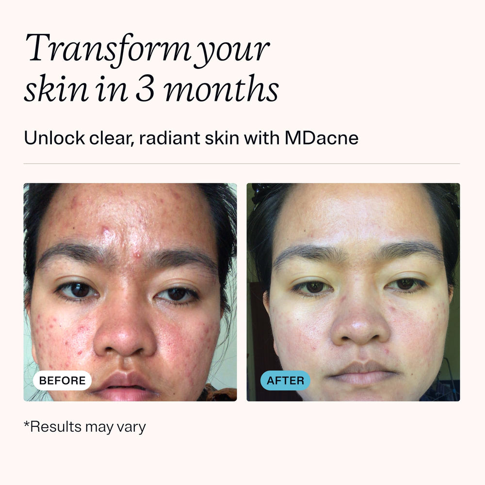 MDacne salicylic acid cleanser bottle ready to lift oil and debris.