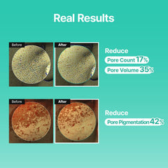 MEDITHERAPY Porethera close-up showing refined skin texture potential.