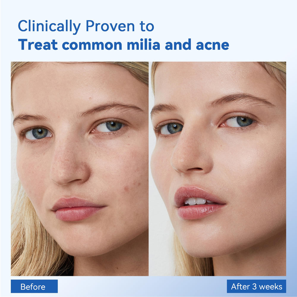 MEOLY Milia Remover on cheek area supports clearer skin around mid-face.