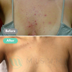 MISUMI Acne Body Wash in 120ml bottle for on-the-go skincare.