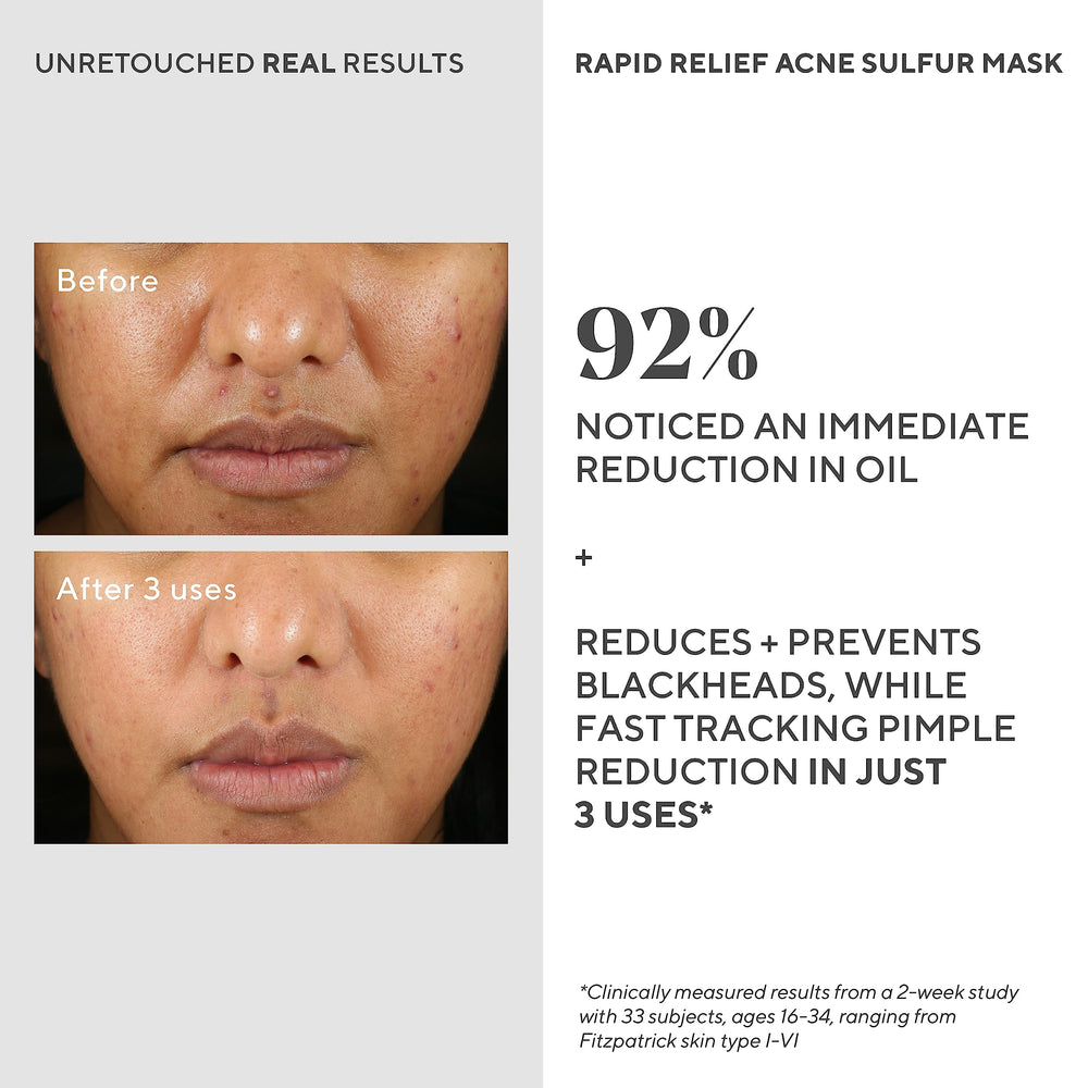 Murad Rapid Relief mask dries on skin in about 10-15 minutes