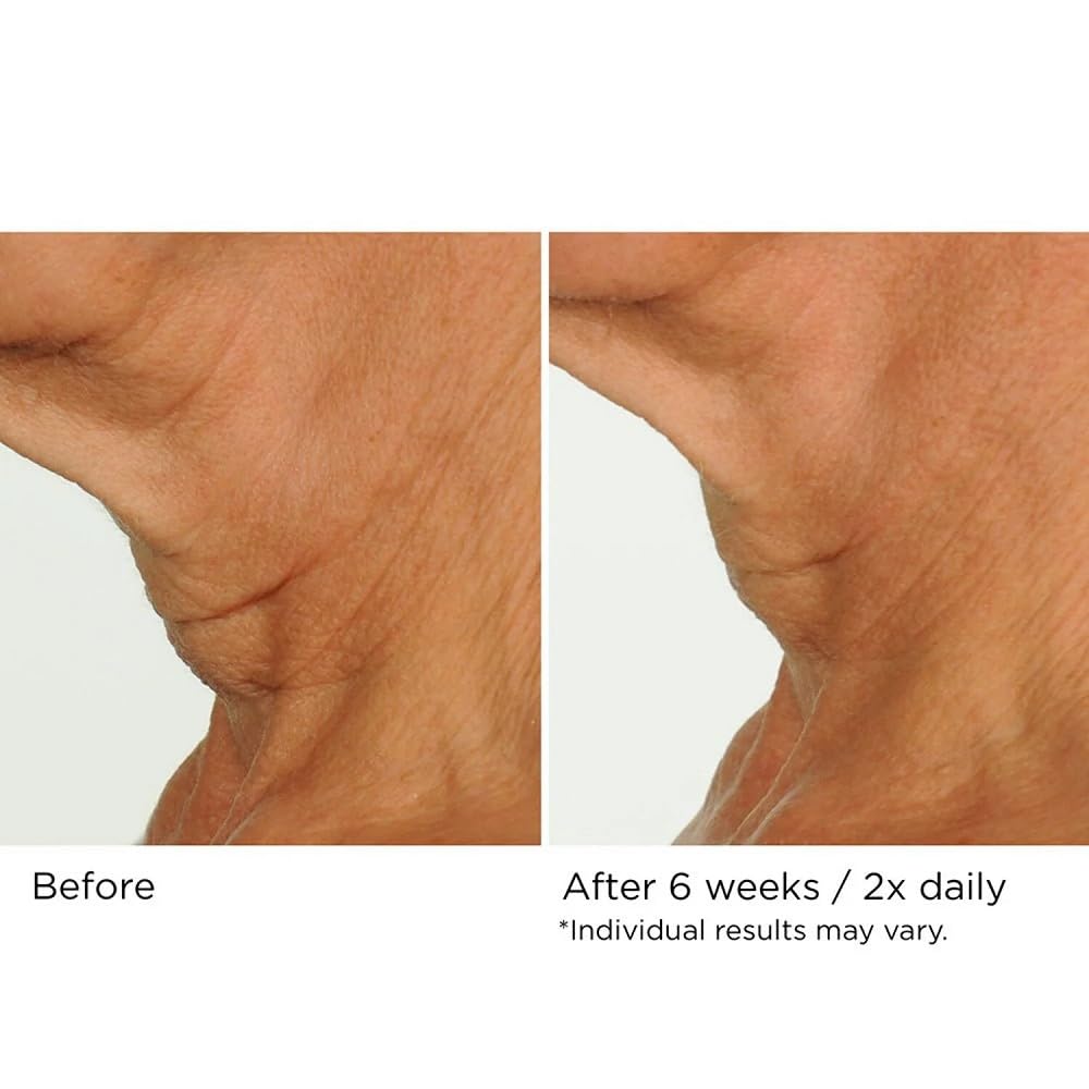 NassifMD Deco-Lift application demonstrating upward strokes on the neck