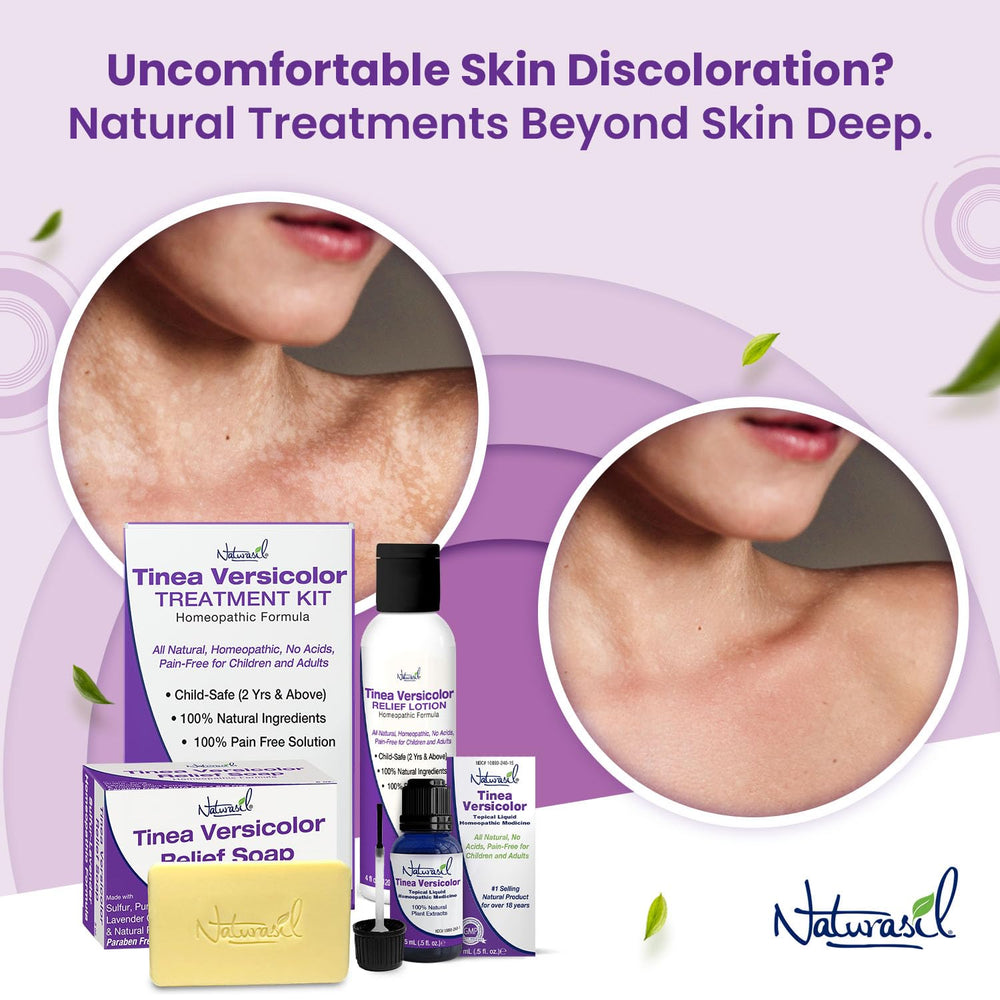Naturasil Tinea Versicolor soap bar side view for gentle cleansing.