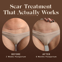 Nemah c-section-scar-recovery application for gentle scar appearance support