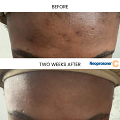 Neoprosone Vitamin C Serum being applied to the cheek for smooth absorption
