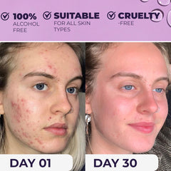 NXN Acne Toner bottle close up illustrating alcohol-free skincare routine