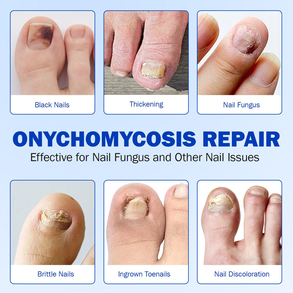 Nyloriaine patch demonstrates visible nail improvement over time.