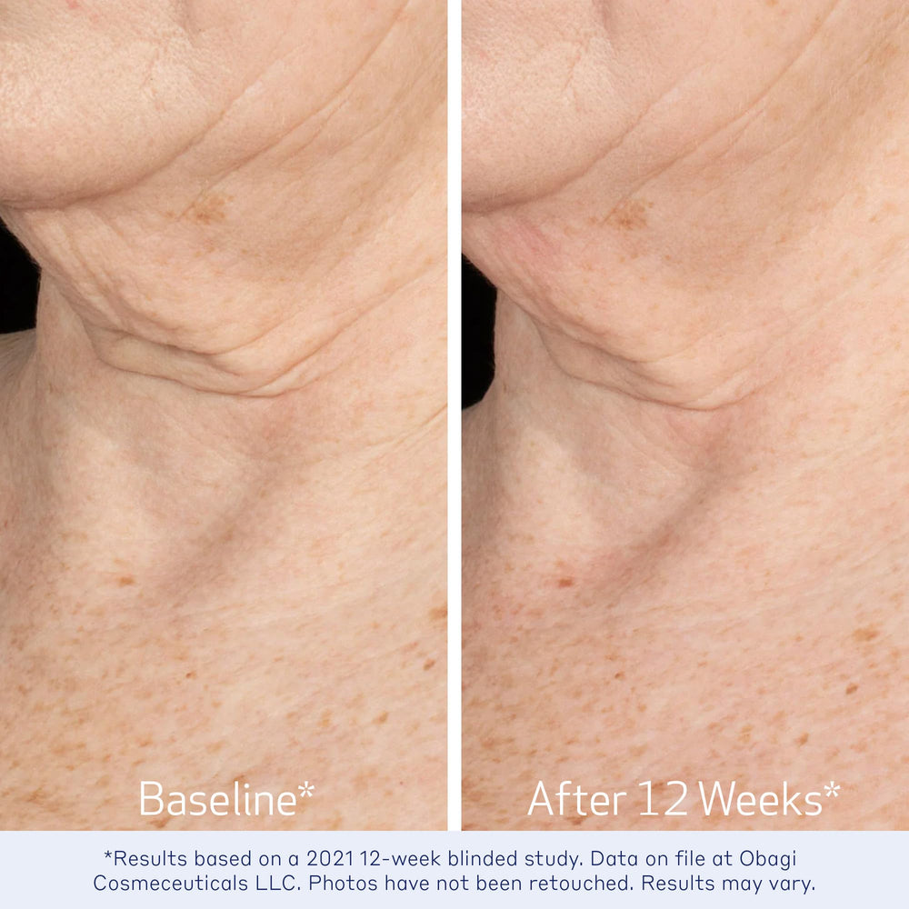 Retinoid smoothing action visual demonstrates texture improvement on the skin.