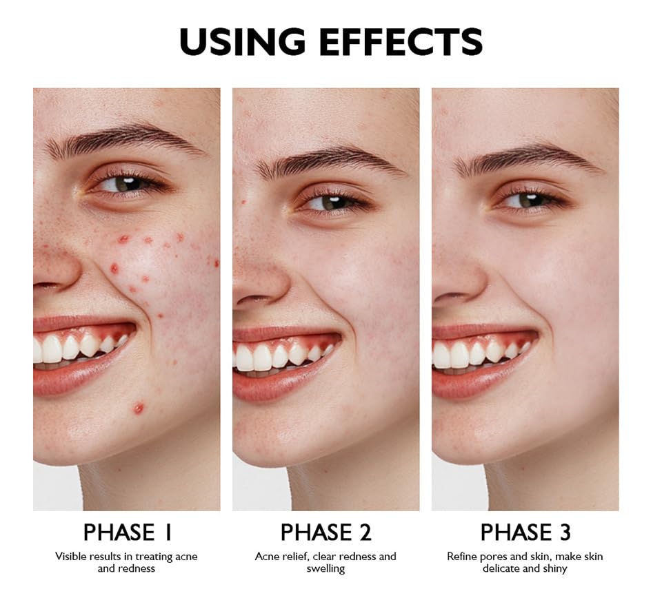 Onkessy Azelaic Acid Serum close-up focusing on refined pores.