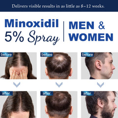 Close-up of OSIMOON Minoxidil 5% with biotin and castor oil ingredients