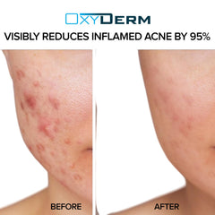 OxyDerm Acne Treatment Pads pore-clearing action helps reduce oil.