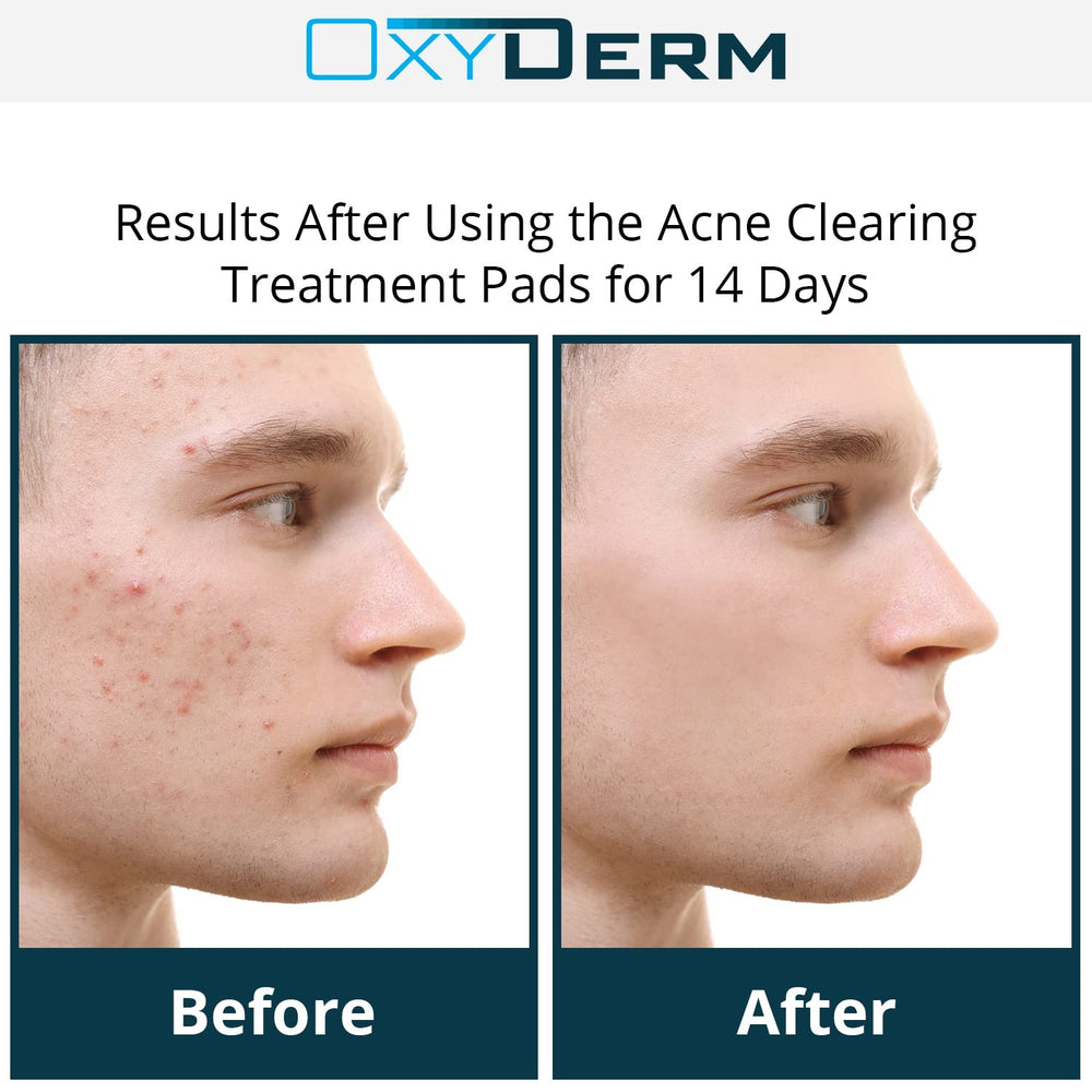 OxyDerm Acne Treatment Pads single pad closeup showing textured surface.