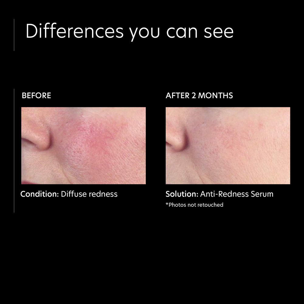 PCA SKIN application area highlight on persistent redness