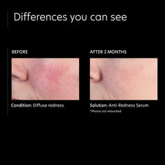 PCA SKIN application area highlight on persistent redness