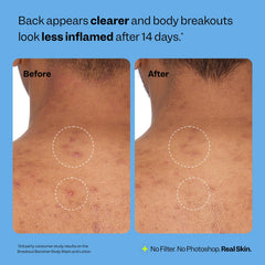 Peach Slices Breakout Banisher glycolic acid exfoliates for smoother skin
