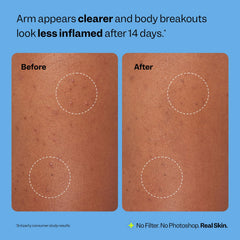 Peach Slices overnight wearable patch helps targeted clusters stay covered while you sleep.