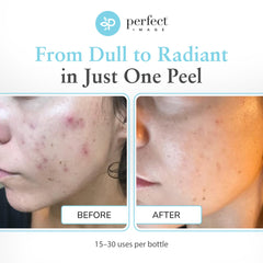 Perfect Image Glycolic 30% Peel gel texture shown for smooth exfoliation.