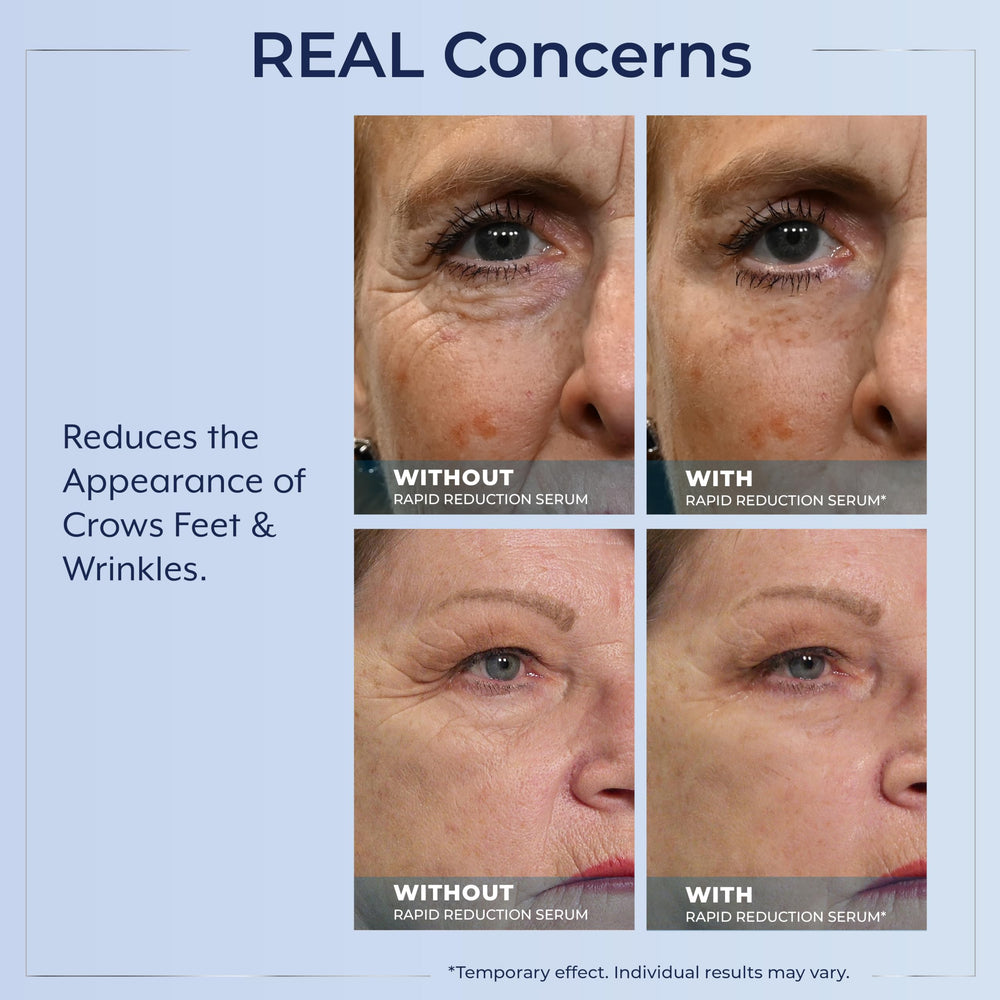 Wrinkles closeup highlighting smoother texture after Plexaderm serum use.