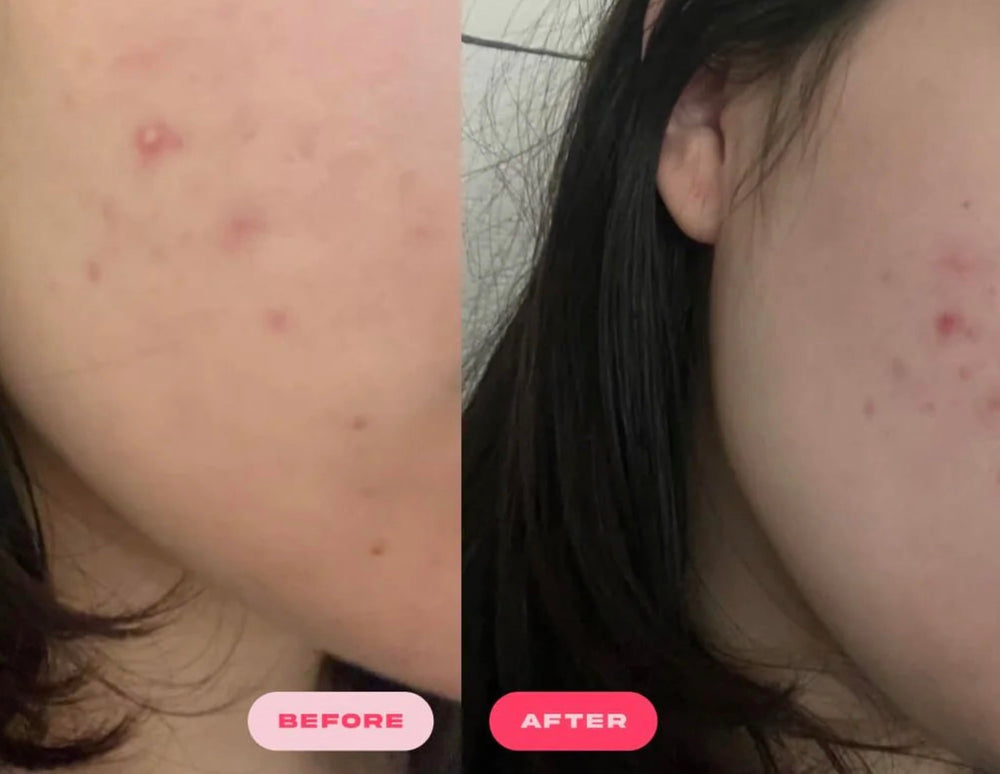 Plumpie Hydro Patch zinc anti-redness soothing swollen skin