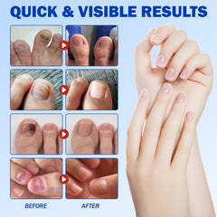 Patch applied to a toe nail showcasing thick, cracked nail care
