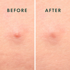 Rael patches applied on the face protect blemishes from irritants during daily activities.