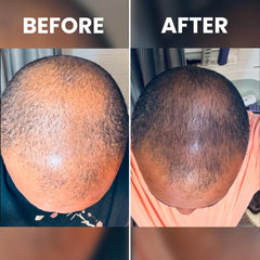 Rennora Hair Growth Serum stinging nettle visual suggests root-friendly botanical blend for growth support.