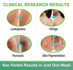 Richie House Vitiligo Cream promotes an even-tone look