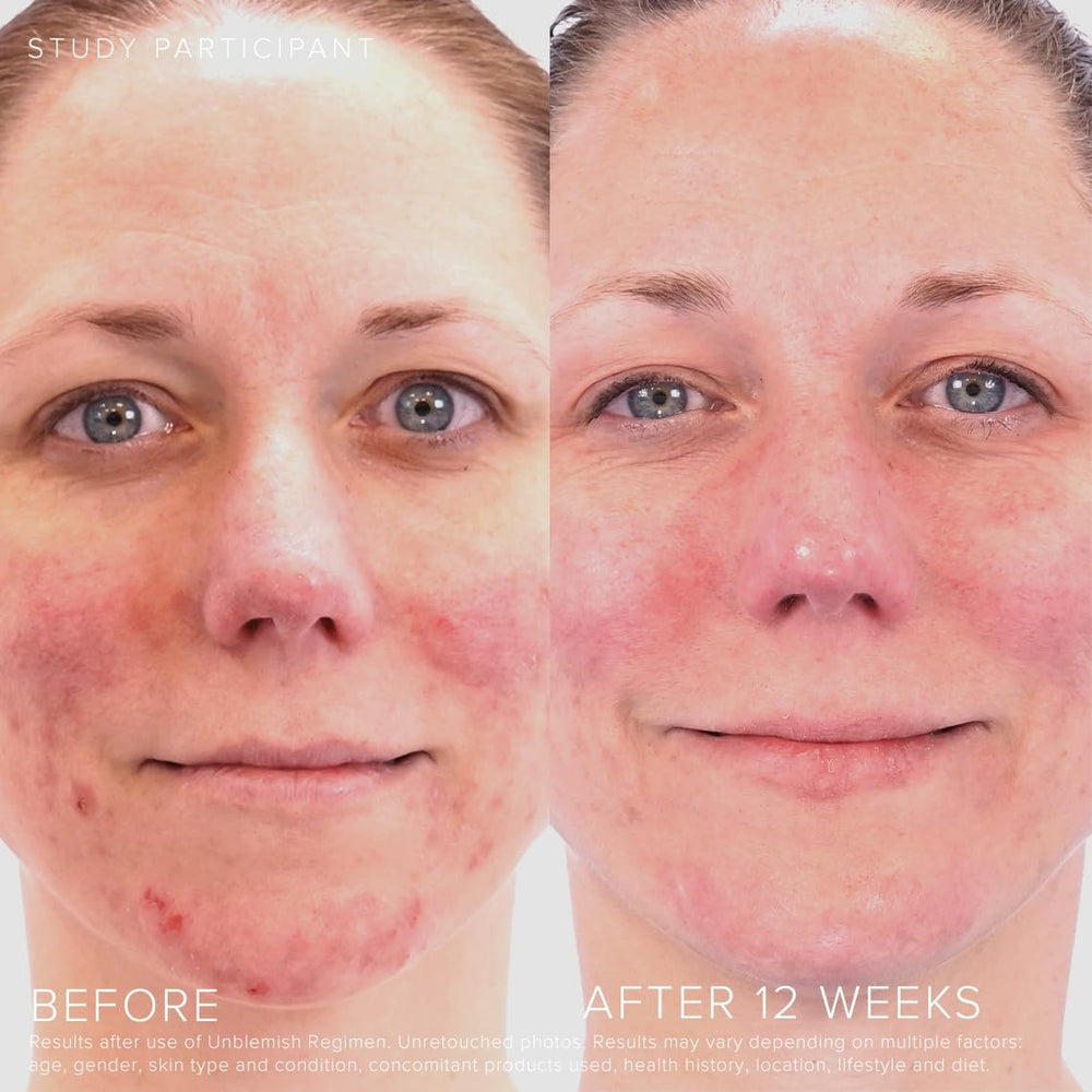 Rodan + Fields Unblemish includes benzoyl peroxide and ceramides for skin comfort.