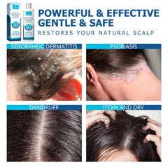 Roycederm Psoriasis Shampoo scalp closeup shows soothing effect.