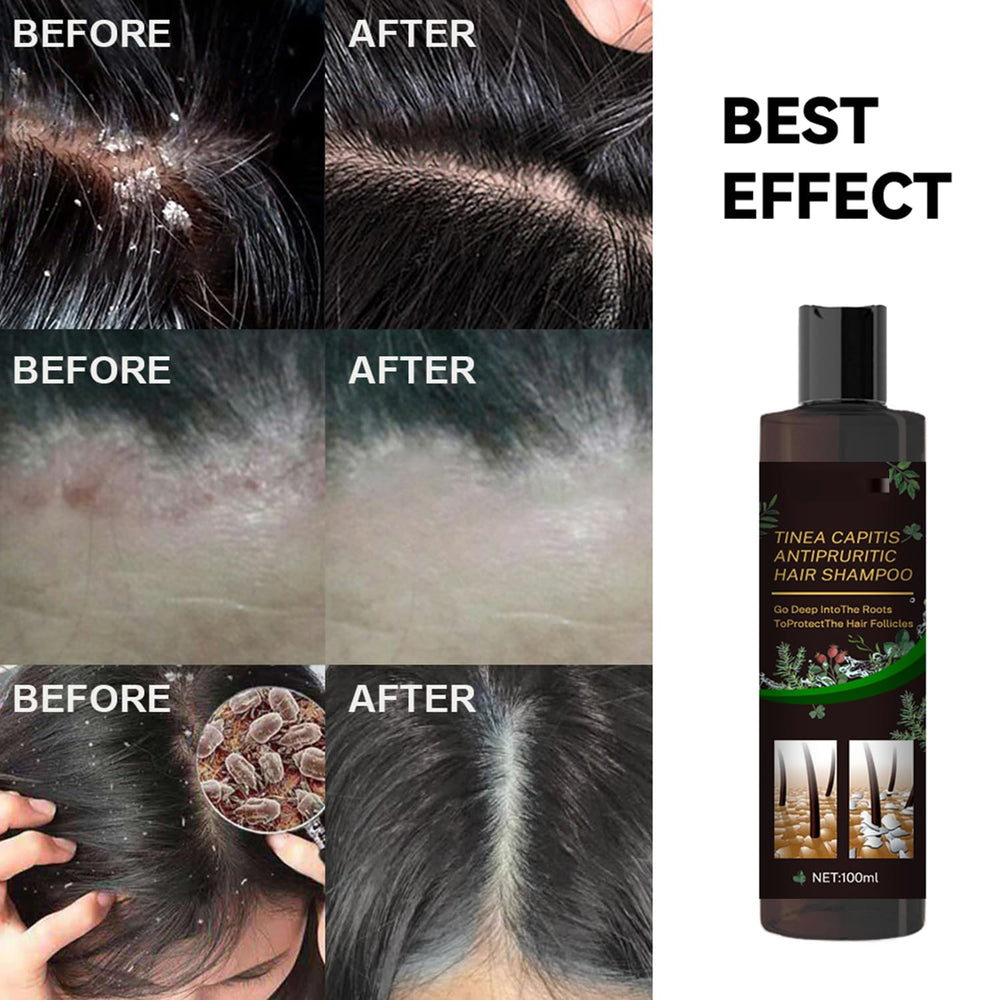 Scalp Flakes Antipruritic Shampoo rich, soothing lather during scalp massage