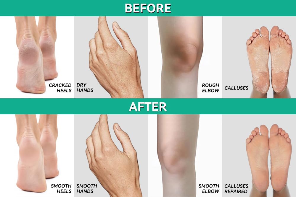 Scientific Solutions Global CLEAR 40% Urea Gel care for dry elbows and hands