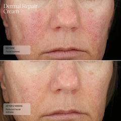 Sente Dermal Repair Cream applied to face demonstrates quick absorption and comfortable finish