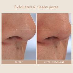 Shani Darden Triple Acid Peel brush included for easy at-home treatment.