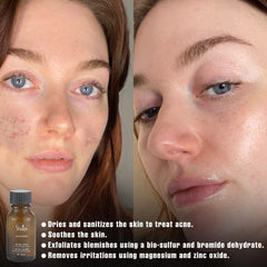 Shira Solar Energy Drying Lotion on blemishes helps reduce oiliness