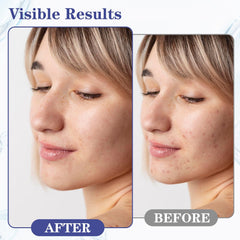 SINPIN AOBENZ Control Gel with 2% salicylic acid helps cleanse pores.
