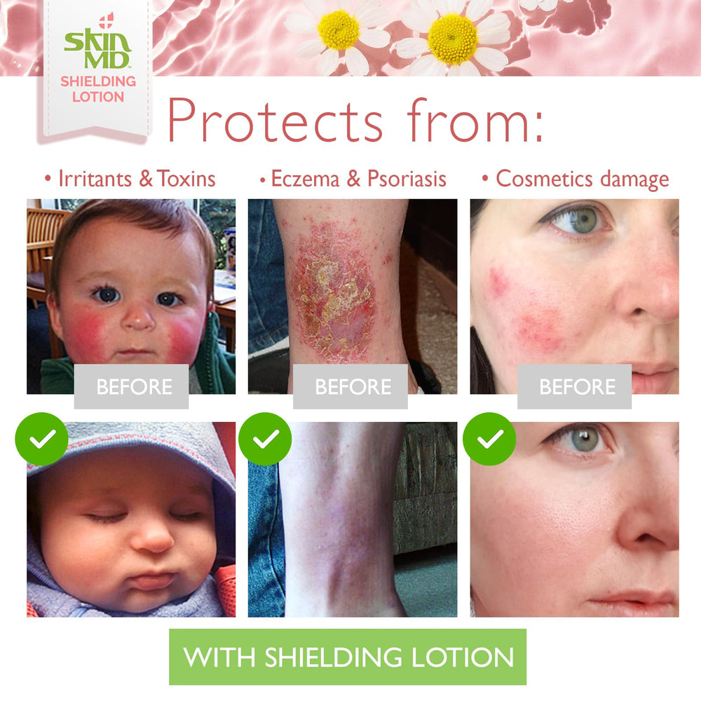 Plant-based ingredients in Skin MD Natural Shielding Lotion: Aloe Vera, Chamomile, Arnica