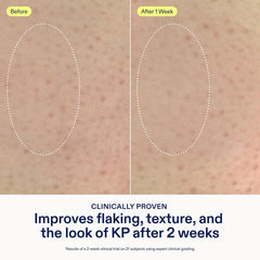 Applying Skinfix KP + PsO Smoothing Body Treatment to damp skin after a shower